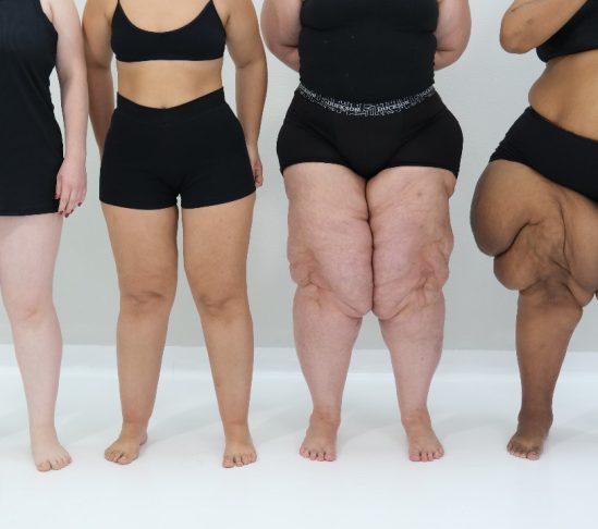 Lipedema Rehabinco